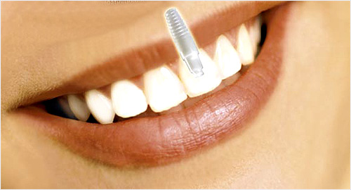 günstige zahnimplantate in kroatien