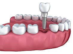 Rovinj Zahnimplantat