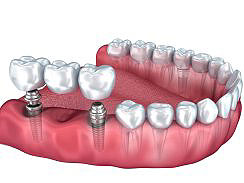Zahnimplantat in Istrien