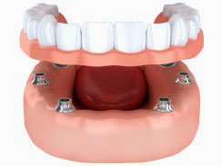 Rovinj Zahnimplantat