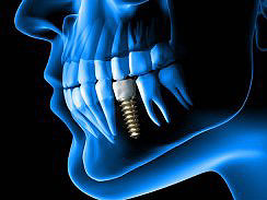 Rovinj Zahnimplantat