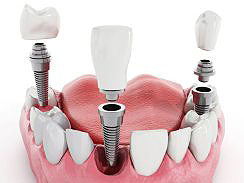 Rovinj Zahnimplantat